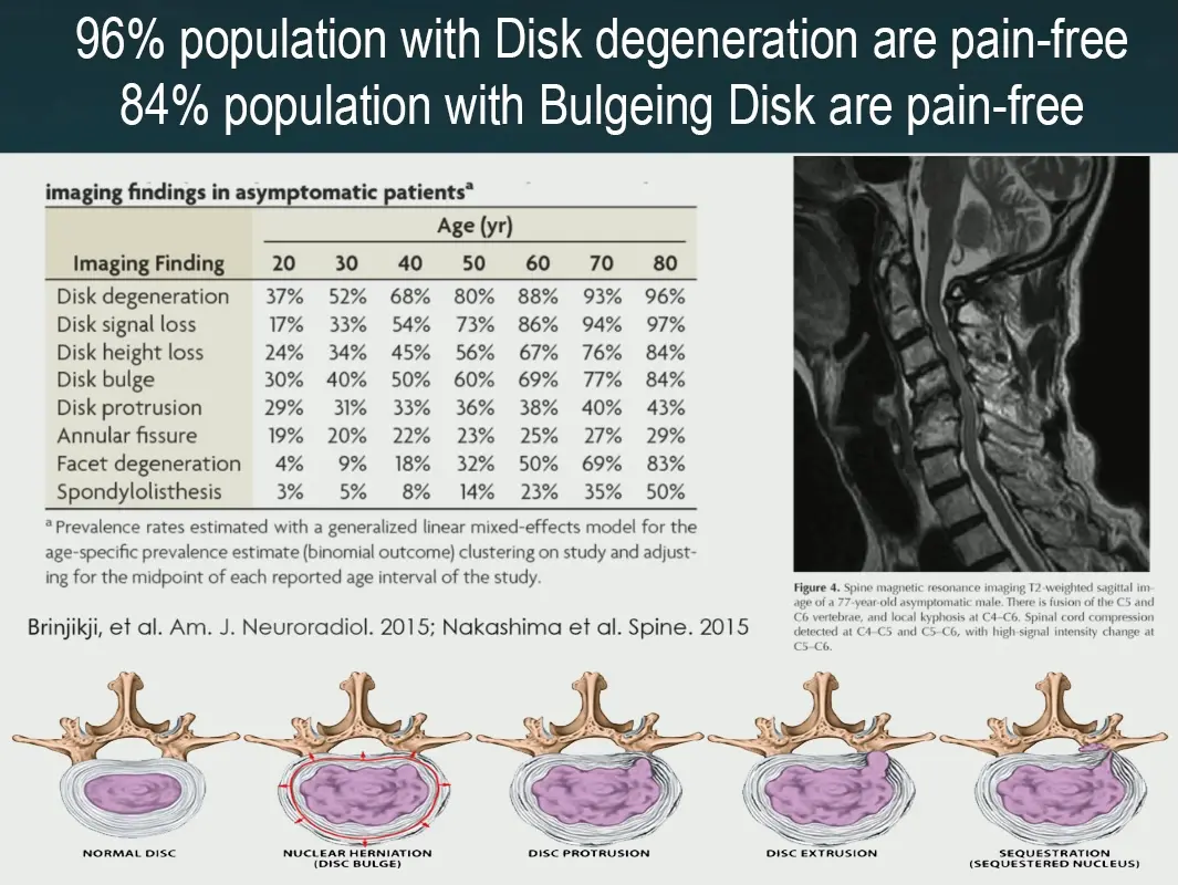 MRI lumbar spine showing multi-level disc herniation — L3/4 with neural canal compromise